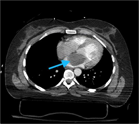 myxoma|what is myxoma cancer.